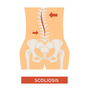 脊柱弯曲脊柱侧凸疾病骨骼疾病载体人类骨干结构紊乱疼痛不适保健和医疗背痛和姿势对齐孤立的身体部分