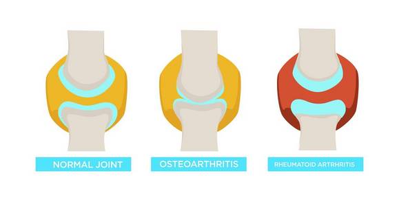 类风湿关节炎和正常关节载体风湿病医学治疗骨骼疾病或损伤医疗保健和疾病人体骨骼部分医疗问题骨骼系统
