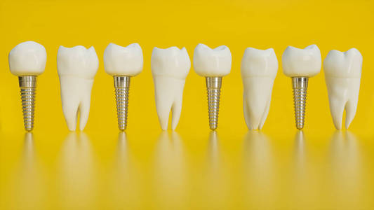 人类种植牙. 人类牙齿或假牙在黄色背景3d渲染上照片