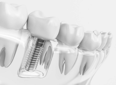 牙齿人类植入物。牙科概念。人牙或假牙..3D渲染