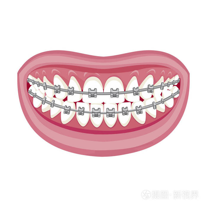 牙医正畸医生. 矢量图. 牙套在牙齿上. 张开嘴. 白色背景.