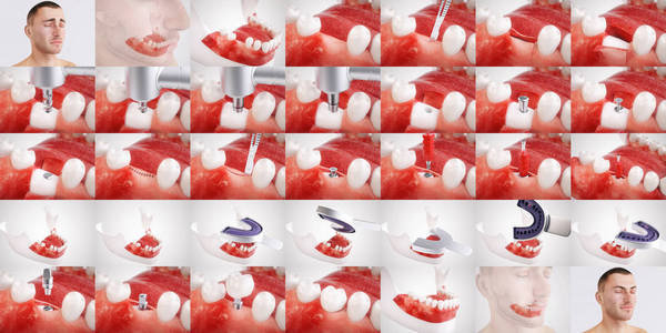 在种植手术的这个顺序中，您将看到使用牙科种植的所有步骤。 这些照片是以最大可能的谨慎创作的。