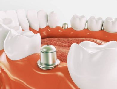 牙种植体在颌骨模型三维渲染的例子上