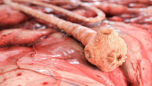 脾脏感染猪肉绦虫图片