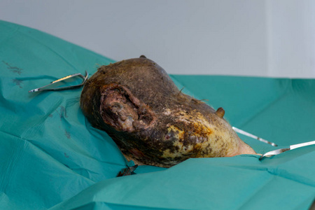 世界乳腺癌癌症日.肿瘤.