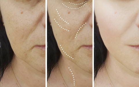 女性面部皱纹矫正前后照片