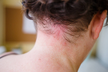 皮肤过敏症患者的症状, 过敏性皮肤反应在女性脖子和胸部。健康问题。牛皮癣皮肤