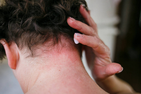 银屑病皮肤的治疗.过敏症的概念照片