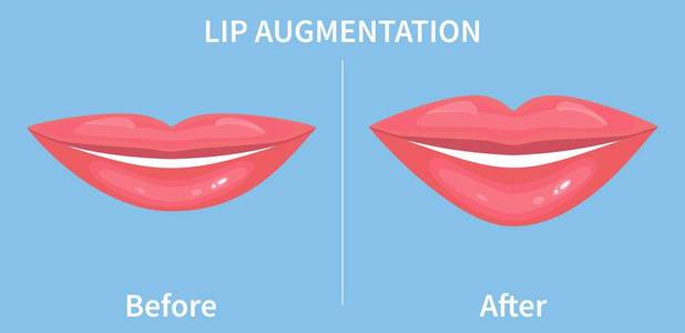 隆唇唇填充剂注射前后。矢量插图