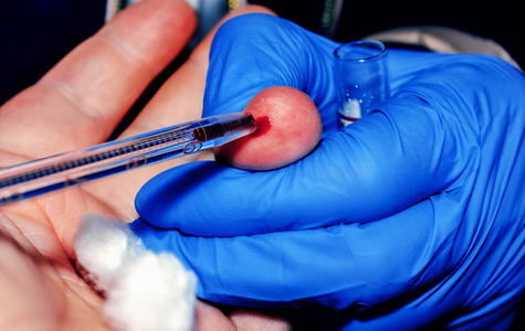 医生从病人的手指上取血照片