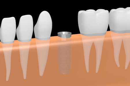 种植牙种植牙