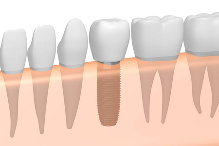 种植牙种植牙
