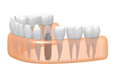 种植牙种植牙