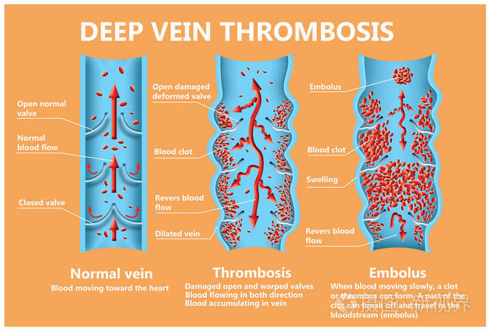 血栓形成从正常血流到血块形成