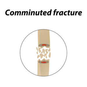 粉碎性骨折骨。信息图表。在内衬背景的向量例证