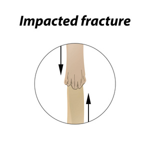 撞击性骨折骨。信息图表。在内衬背景的向量例证
