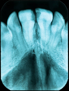牙齿状况不佳的老牙科x射线