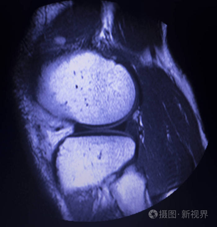磁共振成像mri膝后角内侧半月板撕裂最少的结果.