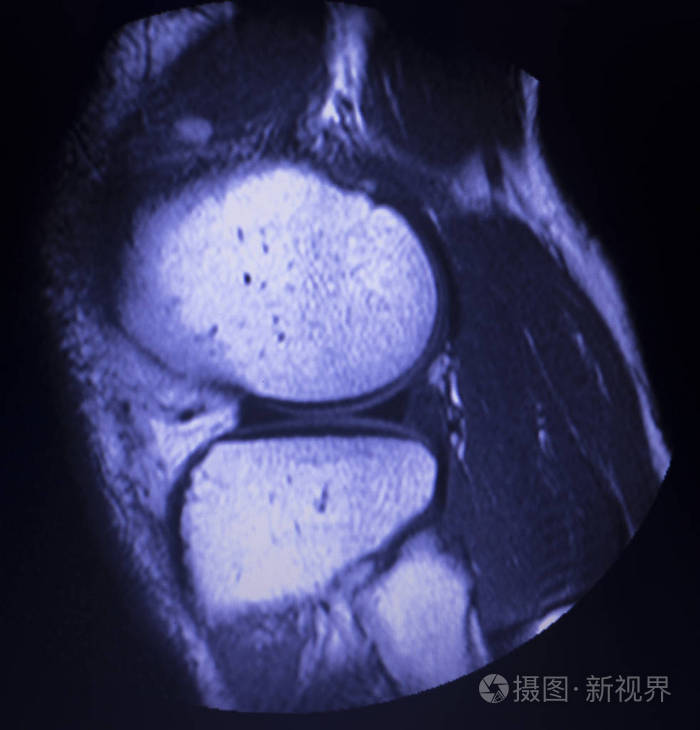 内侧半月板后角撕裂图片