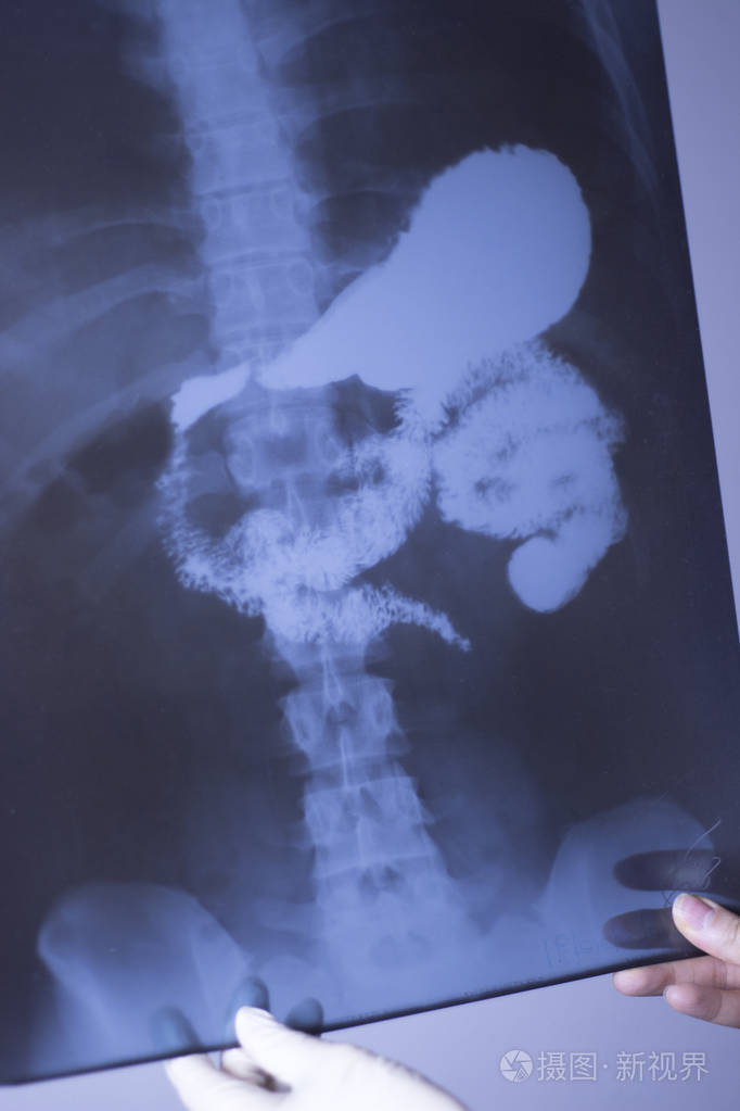 医疗医院x射线腰痛脊柱和臀部创伤扫描也显示胃和器官.