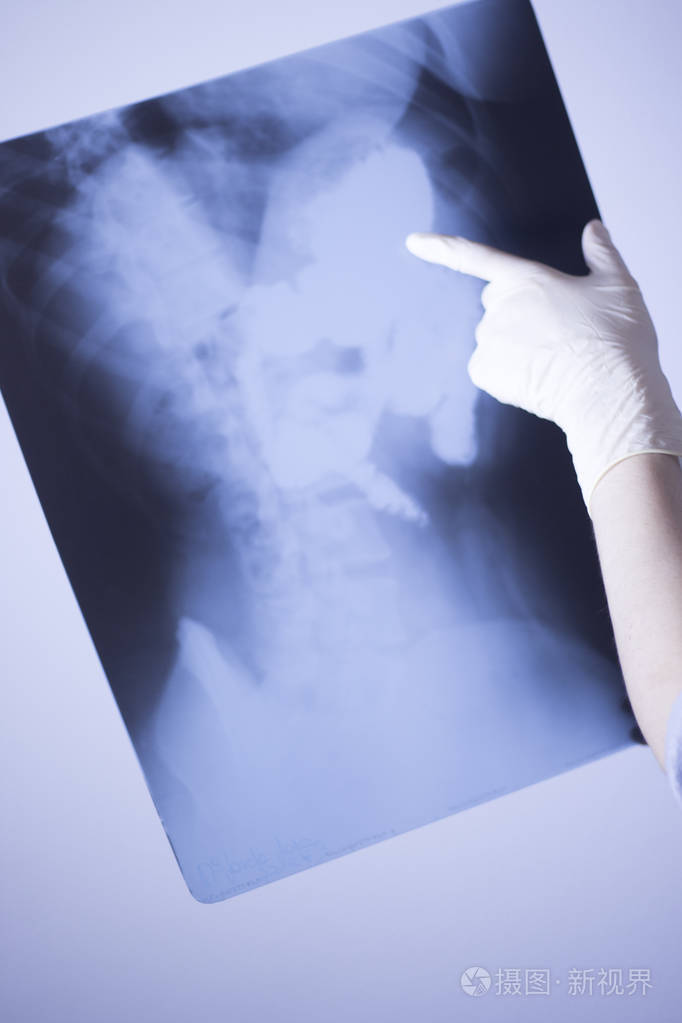 医疗医院x射线腰痛脊柱和臀部创伤扫描也显示胃和器官.