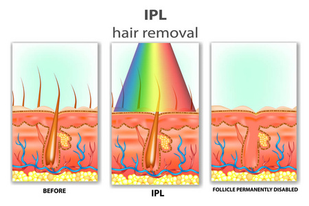 IPL强烈脉冲光.IPL脱毛方法