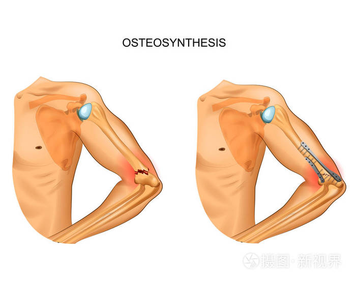 肱骨远端骨折骨合成的矢量图