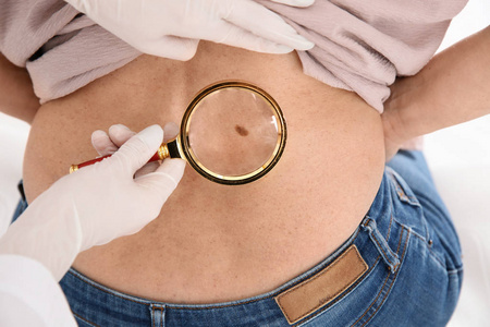 s birthmark with magnifying glass in clinic, closeup