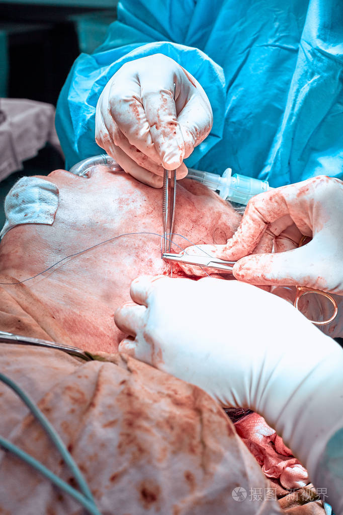 面部整形手术整容手术外科医生将皮肤与患者面部分开
