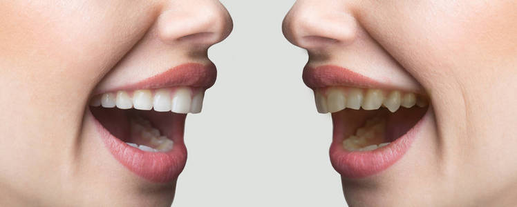 有牙没牙对比牙齿美白, 设置前后, 牙齿对齐.牙科服务, 牙科, 牙医.