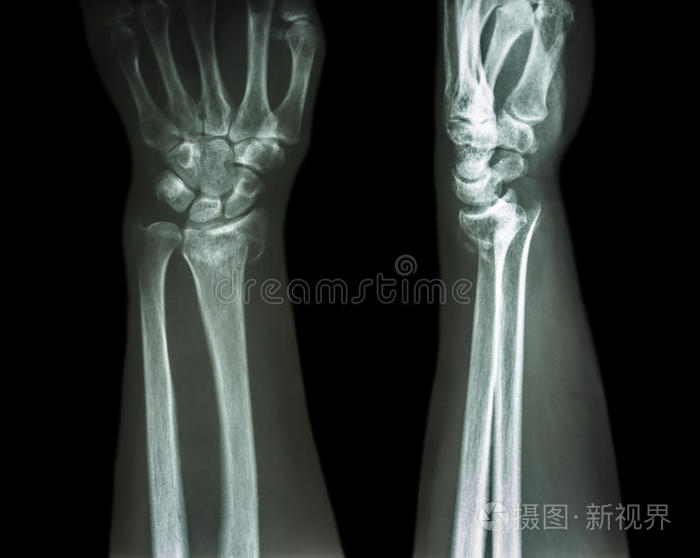 桡骨远端骨折colles骨折