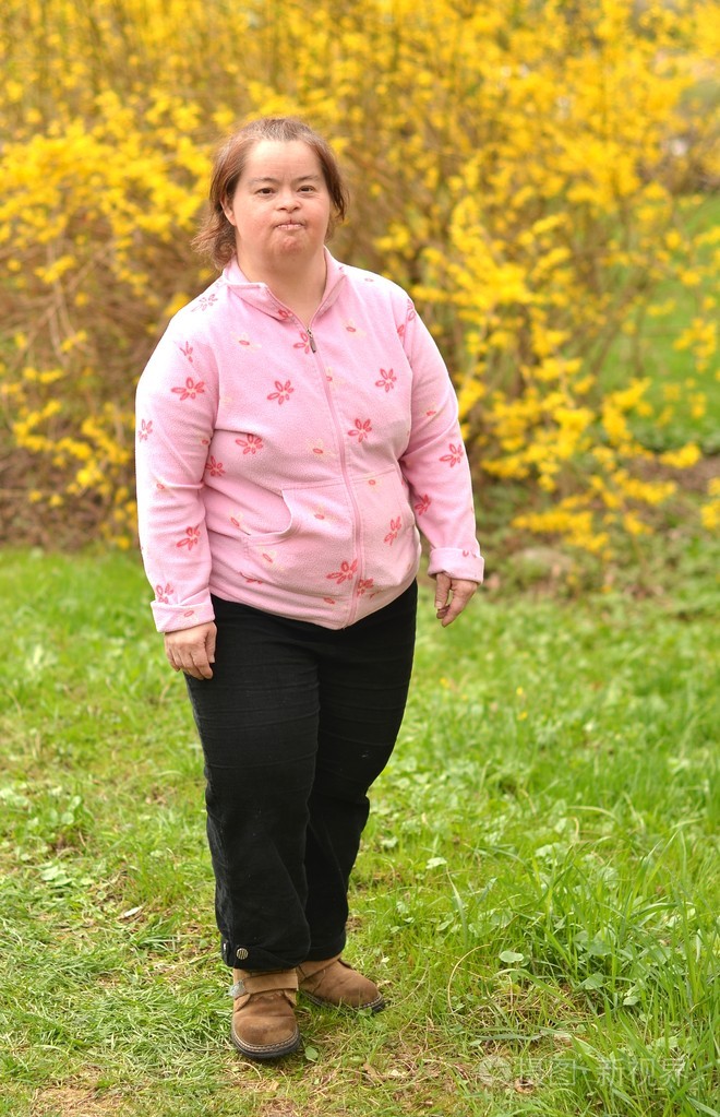 唐氏综合征的女人