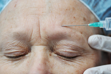 老年女性接受肉毒杆菌注射在额头