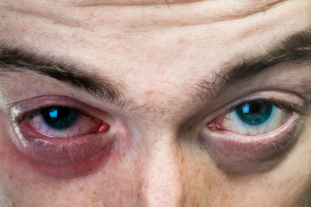 一个人脸上的黑眼圈照片