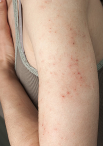 五联疫苗过敏性皮疹图图片