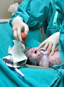 剖宫产