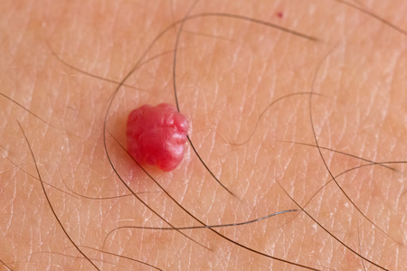 混合型血管瘤图片