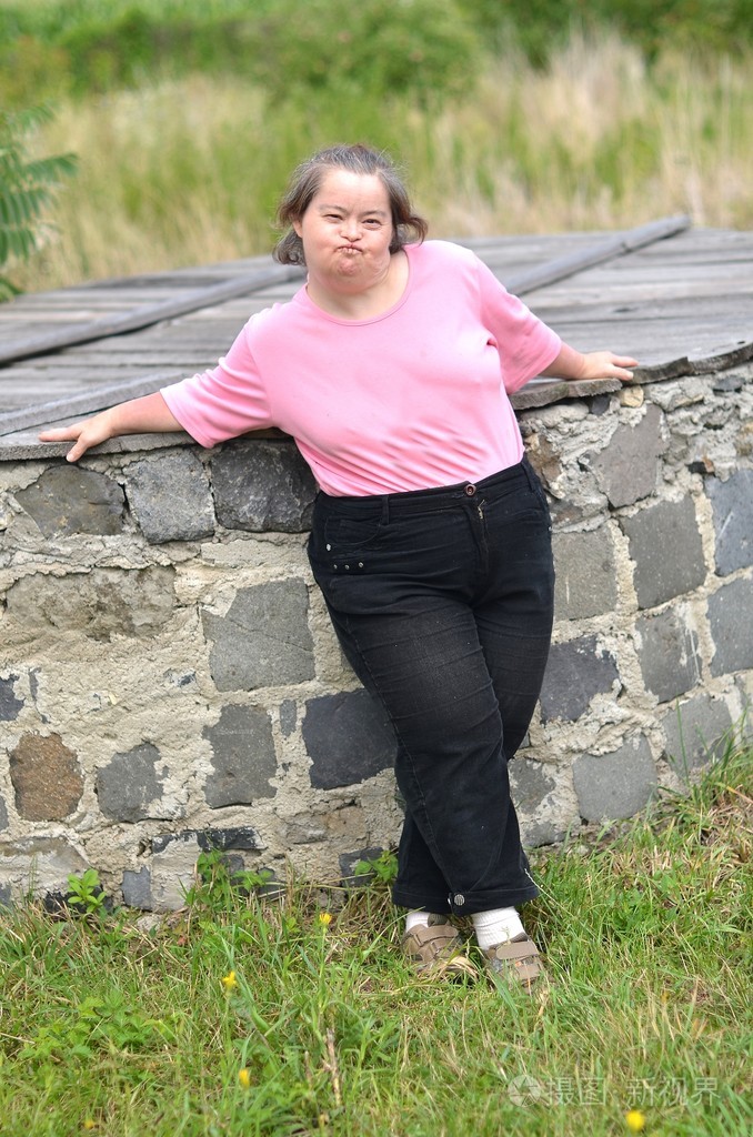 唐氏综合征的女人