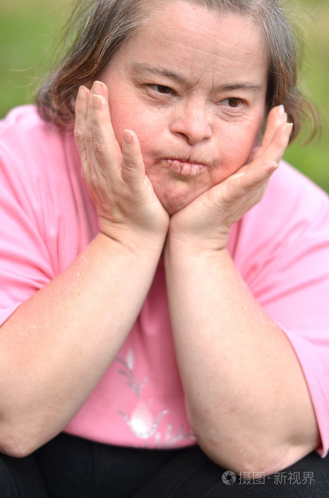 唐氏综合征的女人