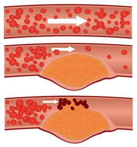 血管脂质斑块图片图片