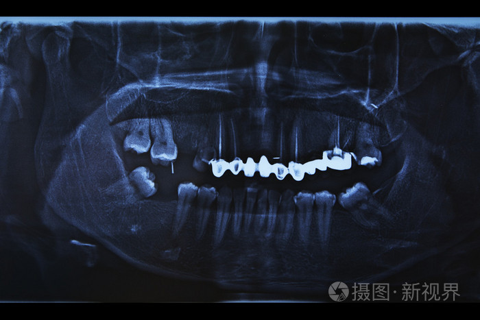 人类牙齿的x光扫描