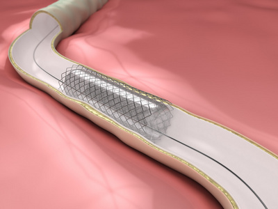 冠状动脉成形术过程ballon 开放腔动脉支架