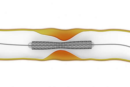 冠状动脉成形术过程血流阻断瘟疫