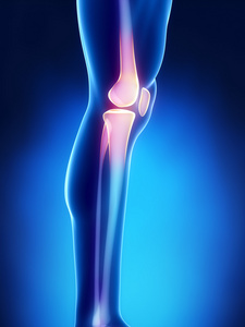 人膝关节肿块股骨, 胫骨和腓骨骨照片