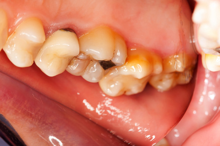 牙齿和牙龈问题牙齿问题照片