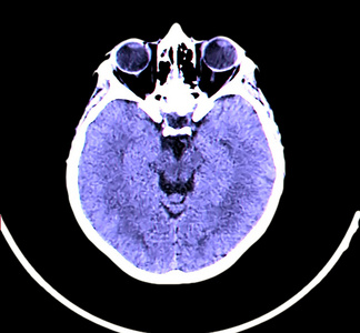 头部的 ct 诊断