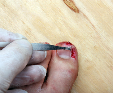 破裂出血的指甲照片