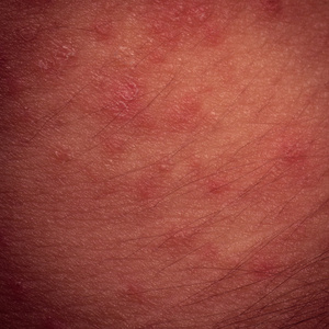 特应性皮炎图片