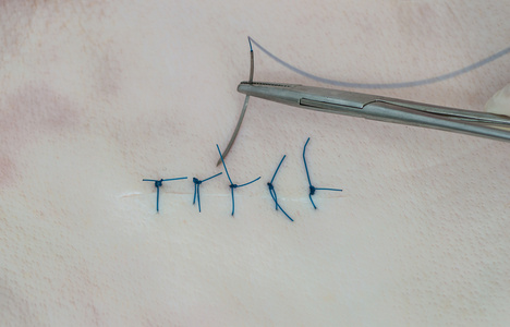 皮肤缝合图片-皮肤缝合素材-皮肤缝合插画-摄图新视界