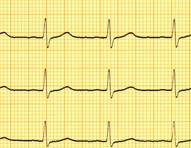 心电波形图片